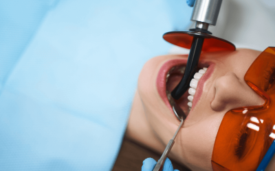 What to Expect During a Root Canal In Albion