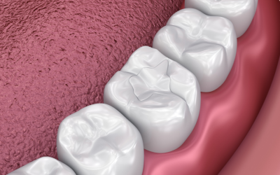 Do I Need Dental Sealants?