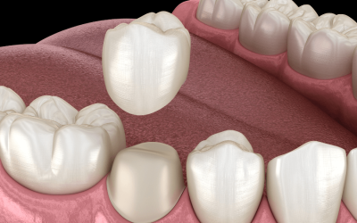 What to Expect if You Need Porcelain Crowns in Albion