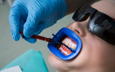 Options for Tooth Whitening in Albion