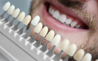 Benefits of Veneers in Albion