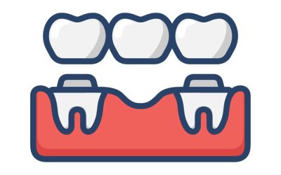 Dental Implants vs. Dental Bridges in Albion