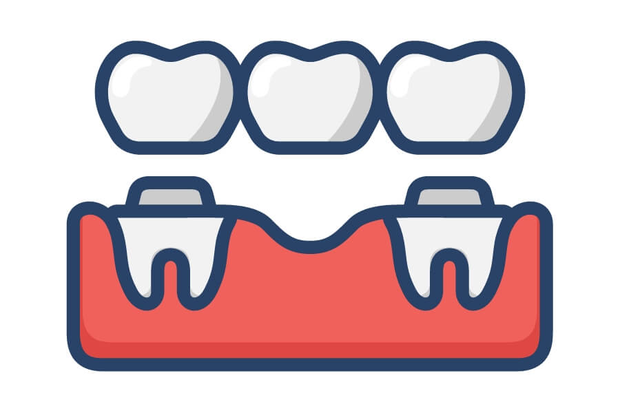 Dental Implants vs. Dental Bridges in Albion