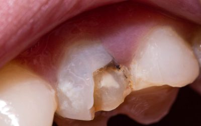 What Should I Do if I Chip My Tooth?