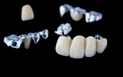 What Are Dental Bridges?