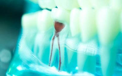 Is a Root Canal or Tooth Extraction Better?
