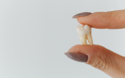 Third Molar Extraction: Do You Really Need Your Wisdom Teeth Removed?