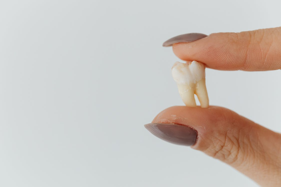 Third Molar Extraction
