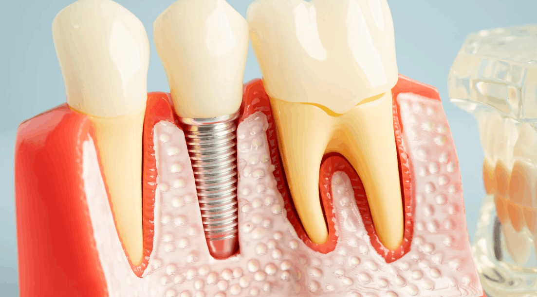 Tooth Implants in Albion