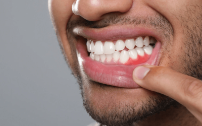 How to Prevent Gum Disease Before It Starts