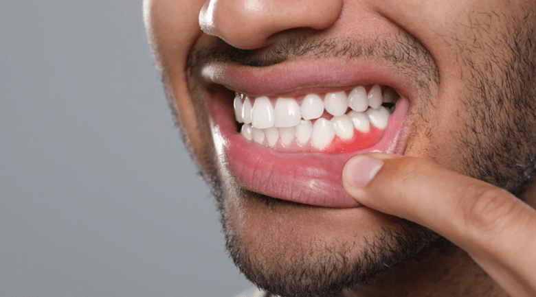 How to Prevent Gum Disease Before It Starts